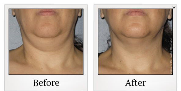 Before and After Photo 8 of Ultherapy treatment at SF Bay Cosmetic Surgery Medical Group in San Ramon