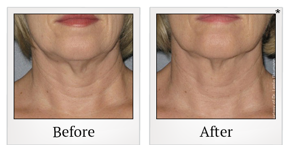 Before and After Photo 9 of Ultherapy treatment at SF Bay Cosmetic Surgery Medical Group in San Ramon