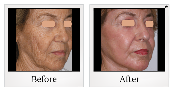 Before and After Photo 1 of UltraPulse® CO2 treatment at SF Bay Cosmetic Surgery Medical Group in San Ramon