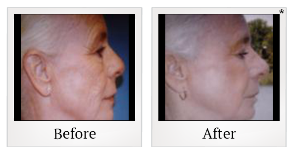 Before and After Photo 4 of UltraPulse® CO2 treatment at SF Bay Cosmetic Surgery Medical Group in San Ramon
