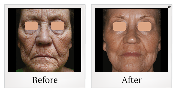 Before and After Photo 2 of UltraPulse® CO2 treatment at SF Bay Cosmetic Surgery Medical Group in San Ramon