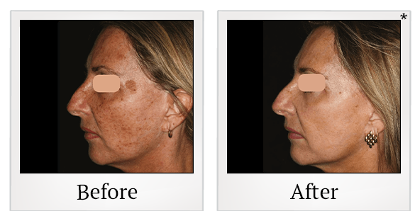 Before and After Photo 3 of UltraPulse® CO2 treatment at SF Bay Cosmetic Surgery Medical Group in San Ramon
