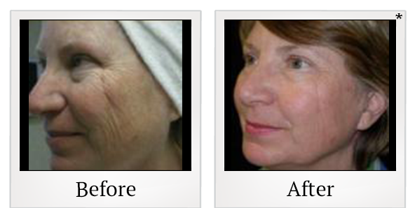 Before and After Photo 7 of UltraPulse® CO2 treatment at SF Bay Cosmetic Surgery Medical Group in San Ramon