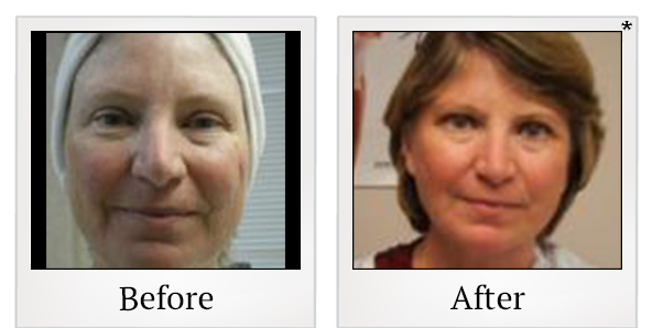 Before and After Photo 8 of UltraPulse® CO2 treatment at SF Bay Cosmetic Surgery Medical Group in San Ramon