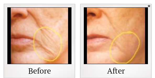Before and After Photo 5 of UltraPulse® CO2 treatment at SF Bay Cosmetic Surgery Medical Group in San Ramon