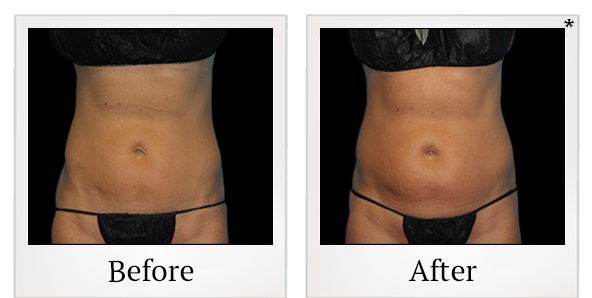 Before and After Photo 1 of Vanquish ME™ treatment at SF Bay Cosmetic Surgery Medical Group in San Ramon