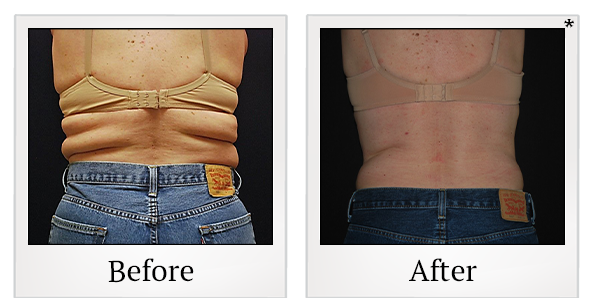 Before and After Photo 10 of Vanquish ME™ treatment at SF Bay Cosmetic Surgery Medical Group in San Ramon