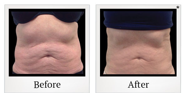Before and After Photo 11 of Vanquish ME™ treatment at SF Bay Cosmetic Surgery Medical Group in San Ramon