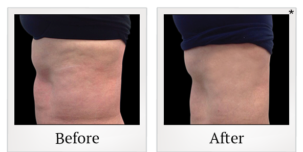 Before and After Photo 12 of Vanquish ME™ treatment at SF Bay Cosmetic Surgery Medical Group in San Ramon