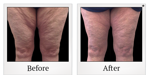 Before and After Photo 13 of Vanquish ME™ treatment at SF Bay Cosmetic Surgery Medical Group in San Ramon