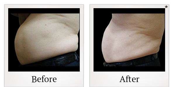 Before and After Photo 14 of Vanquish ME™ treatment at SF Bay Cosmetic Surgery Medical Group in San Ramon