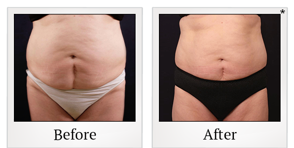 Before and After Photo 15 of Vanquish ME™ treatment at SF Bay Cosmetic Surgery Medical Group in San Ramon
