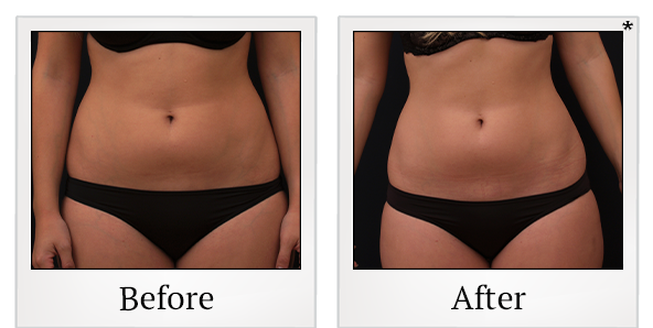 Before and After Photo 16 of Vanquish ME™ treatment at SF Bay Cosmetic Surgery Medical Group in San Ramon