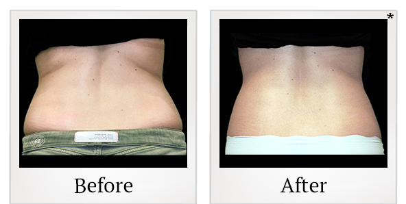 Before and After Photo 17 of Vanquish ME™ treatment at SF Bay Cosmetic Surgery Medical Group in San Ramon