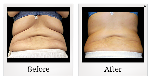 Before and After Photo 18 of Vanquish ME™ treatment at SF Bay Cosmetic Surgery Medical Group in San Ramon