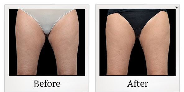 Before and After Photo 19 of Vanquish ME™ treatment at SF Bay Cosmetic Surgery Medical Group in San Ramon