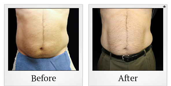 Before and After Photo 2 of Vanquish ME™ treatment at SF Bay Cosmetic Surgery Medical Group in San Ramon