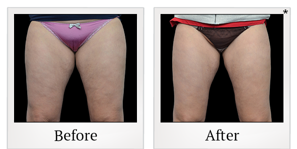 Before and After Photo 20 of Vanquish ME™ treatment at SF Bay Cosmetic Surgery Medical Group in San Ramon