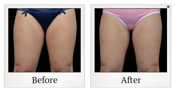 Before and After Photo 21 of Vanquish ME™ treatment at SF Bay Cosmetic Surgery Medical Group in San Ramon