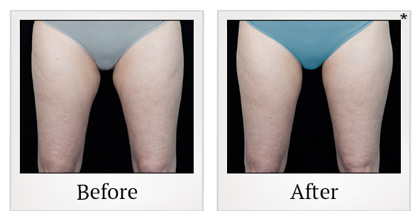 Before and After Photo 22 of Vanquish ME™ treatment at SF Bay Cosmetic Surgery Medical Group in San Ramon