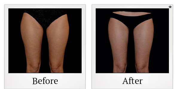 Before and After Photo 23 of Vanquish ME™ treatment at SF Bay Cosmetic Surgery Medical Group in San Ramon