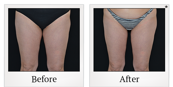 Before and After Photo 24 of Vanquish ME™ treatment at SF Bay Cosmetic Surgery Medical Group in San Ramon