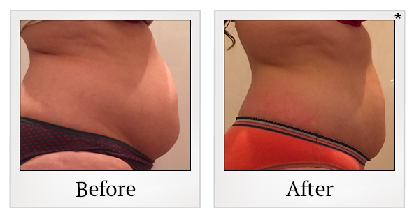 Before and After Photo 25 of Vanquish ME™ treatment at SF Bay Cosmetic Surgery Medical Group in San Ramon