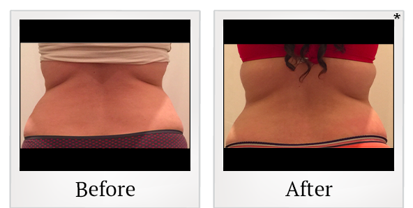 Before and After Photo 26 of Vanquish ME™ treatment at SF Bay Cosmetic Surgery Medical Group in San Ramon