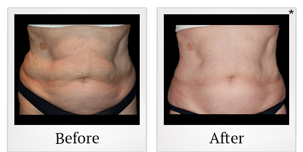 Before and After Photo 3 of Vanquish ME™ treatment at SF Bay Cosmetic Surgery Medical Group in San Ramon