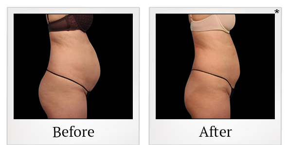 Before and After Photo 4 of Vanquish ME™ treatment at SF Bay Cosmetic Surgery Medical Group in San Ramon