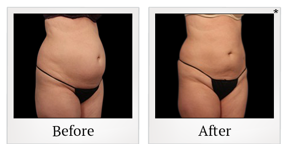 Before and After Photo 5 of Vanquish ME™ treatment at SF Bay Cosmetic Surgery Medical Group in San Ramon