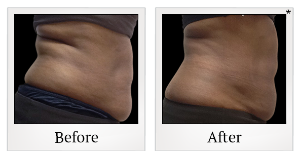 Before and After Photo 6 of Vanquish ME™ treatment at SF Bay Cosmetic Surgery Medical Group in San Ramon