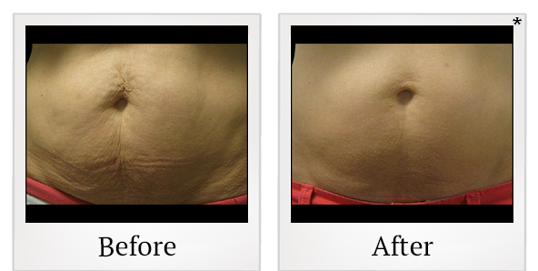 Before and After Photo 7 of Vanquish ME™ treatment at SF Bay Cosmetic Surgery Medical Group in San Ramon