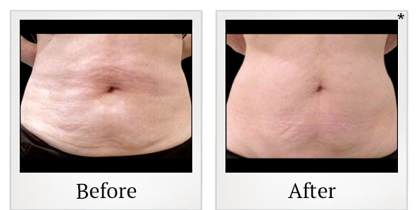 Before and After Photo 8 of Vanquish ME™ treatment at SF Bay Cosmetic Surgery Medical Group in San Ramon
