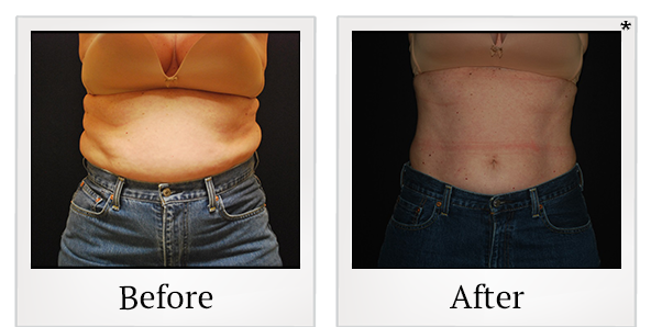 Before and After Photo 9 of Vanquish ME™ treatment at SF Bay Cosmetic Surgery Medical Group in San Ramon