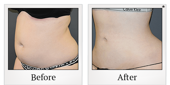 Before and After Photo 2 of Vaser Hi-Def Ultrasound Lipo treatment at SF Bay Cosmetic Surgery Medical Group in San Ramon