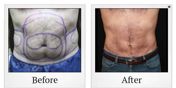 Before and After Photo 5 of Vaser Hi-Def Ultrasound Lipo treatment at SF Bay Cosmetic Surgery Medical Group in San Ramon