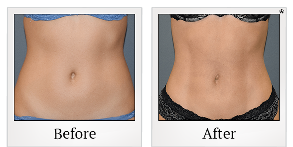 Before and After Photo 1 of Smartlipo® & Lipo treatment at SF Bay Cosmetic Surgery Medical Group in San Ramon