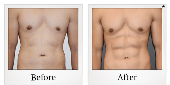 Before and After Photo 3 of Smartlipo® & Lipo treatment at SF Bay Cosmetic Surgery Medical Group in San Ramon