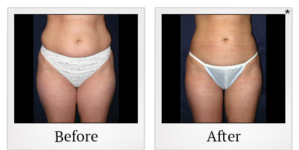 Before and After Photo 1 of Vaser® Shape treatment at SF Bay Cosmetic Surgery Medical Group in San Ramon