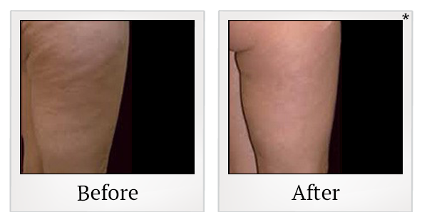 Before and After Photo 1 of Vaser® Smooth treatment at SF Bay Cosmetic Surgery Medical Group in San Ramon