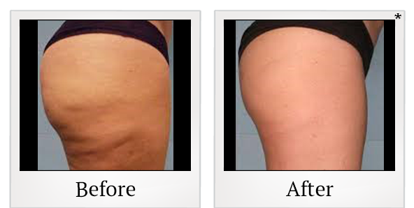 Before and After Photo 2 of Vaser® Smooth treatment at SF Bay Cosmetic Surgery Medical Group in San Ramon