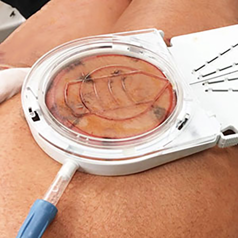 Image of patient being treated with Cellfina
