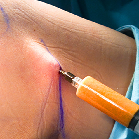 Treat wrinkles with our Fat Transfers at SF Bay Cosmetic Surgery Medical Group in San Ramon