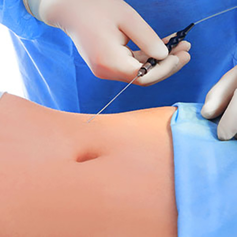 Treat jowls with our Smartlipo® & Lipo at SF Bay Cosmetic Surgery Medical Group in San Ramon