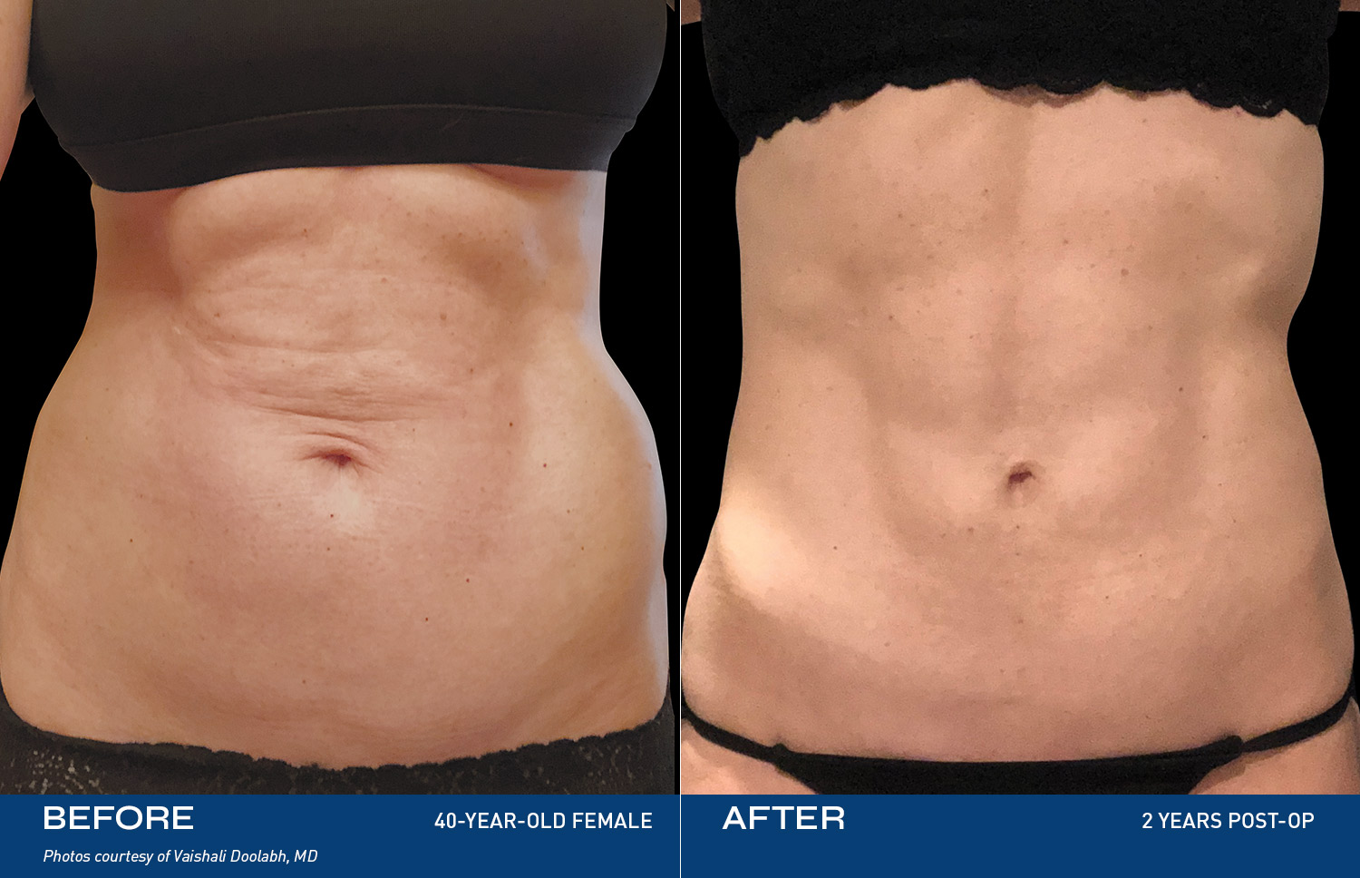Renuvion Treatment Areas