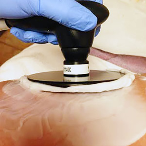 Image of patient being treated with ThermiSmooth Body