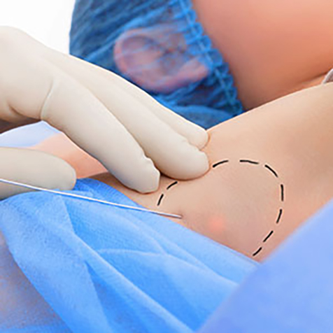 Treat bat wings with our Thermitight® at SF Bay Cosmetic Surgery Medical Group in San Ramon