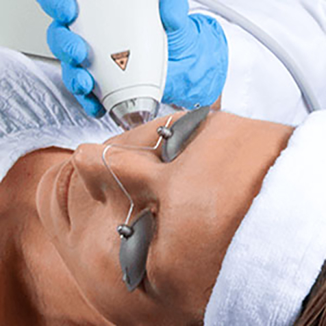 Treat Hyperpigmentation with our Clear + Brilliant® at SF Bay Cosmetic Surgery Medical Group in San Ramon