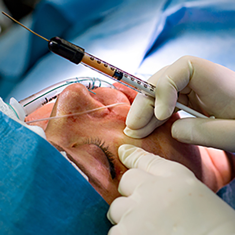 Treat hyperpigmentation with our Facial Rejuvenation at SF Bay Cosmetic Surgery Medical Group in San Ramon